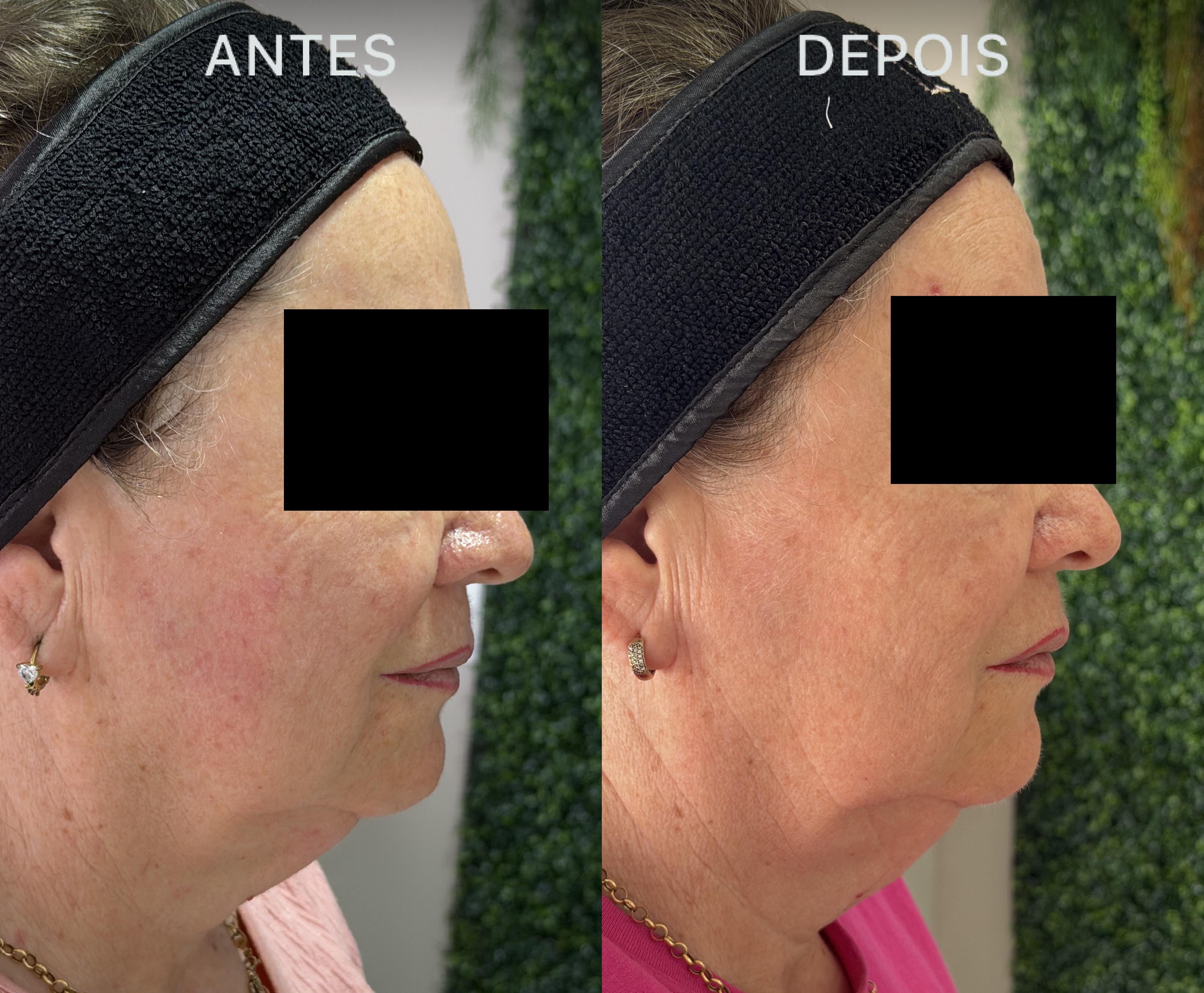 Antes e Depois Dra Lívia 16