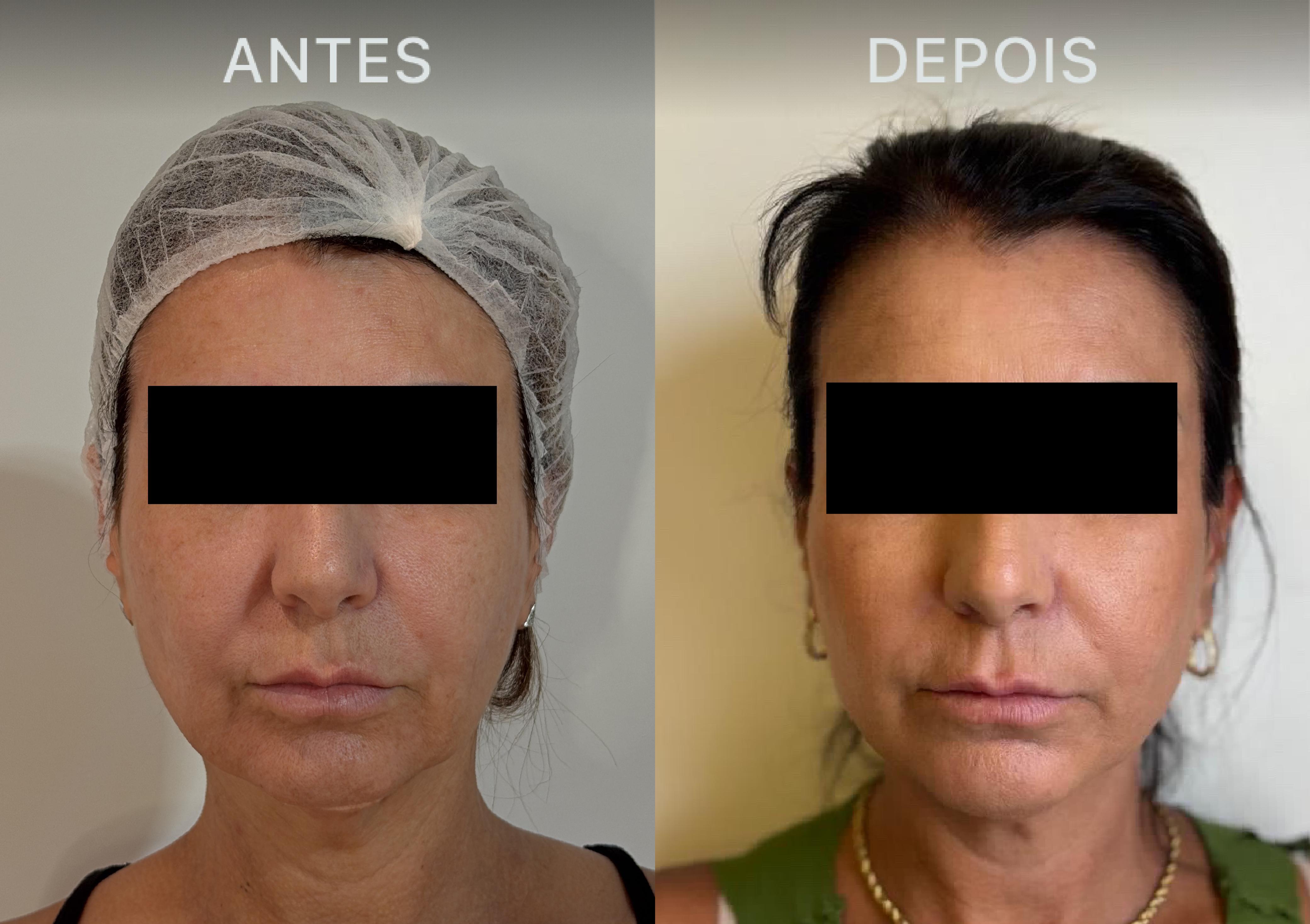 Antes e Depois Dra Lívia 17
