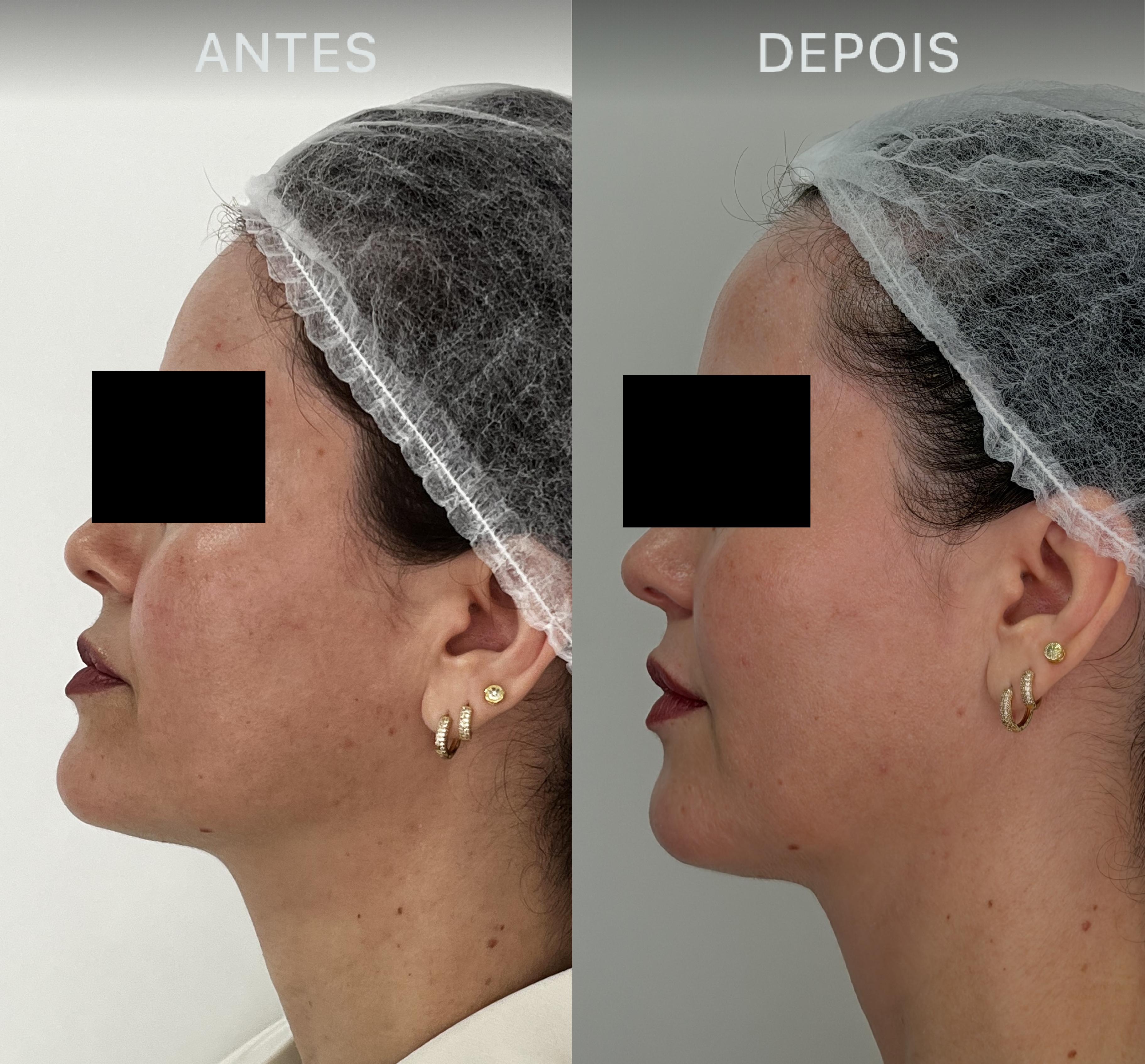 Antes e Depois Dra Lívia 22