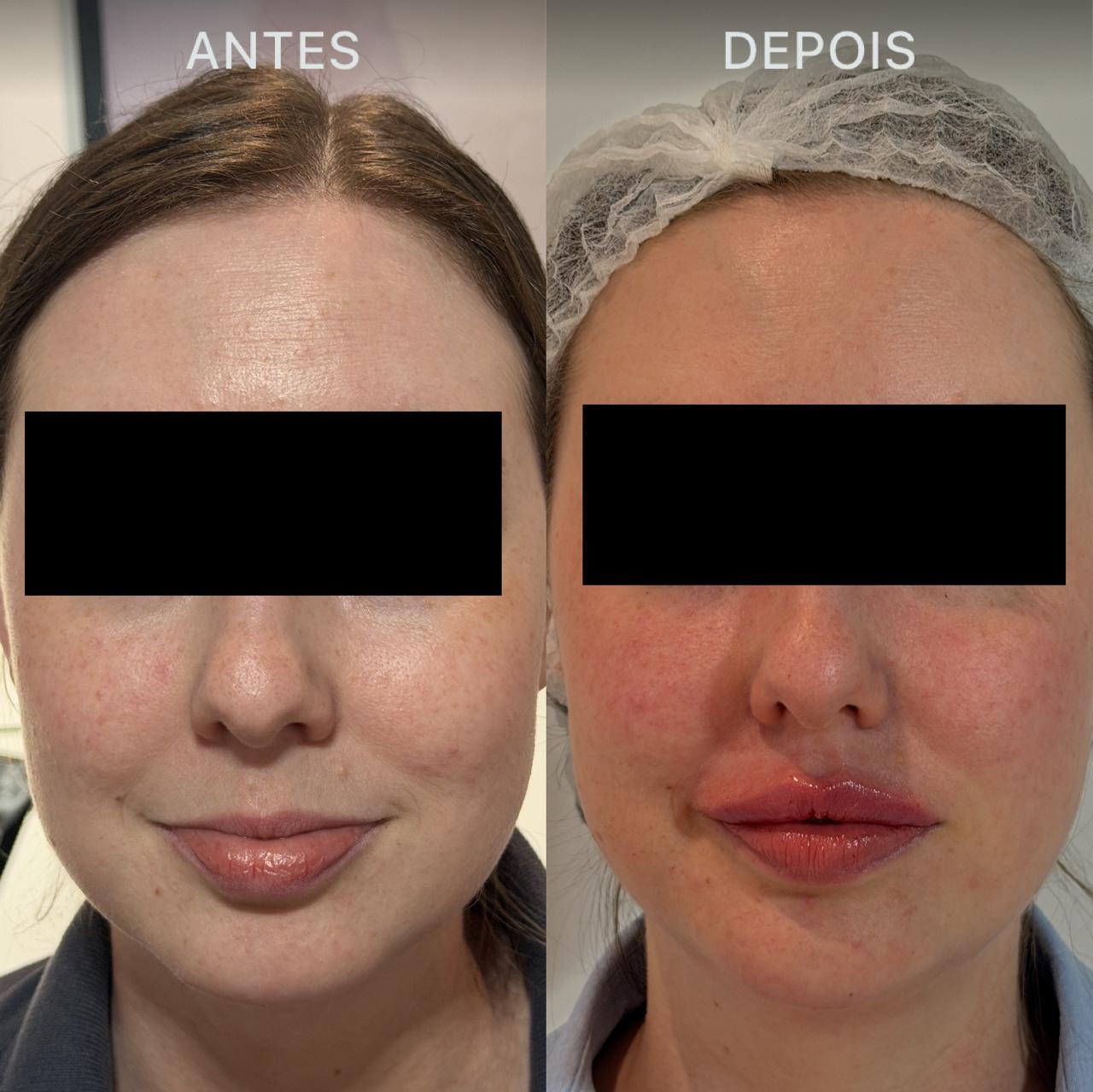 Antes e Depois Dra Lívia 30