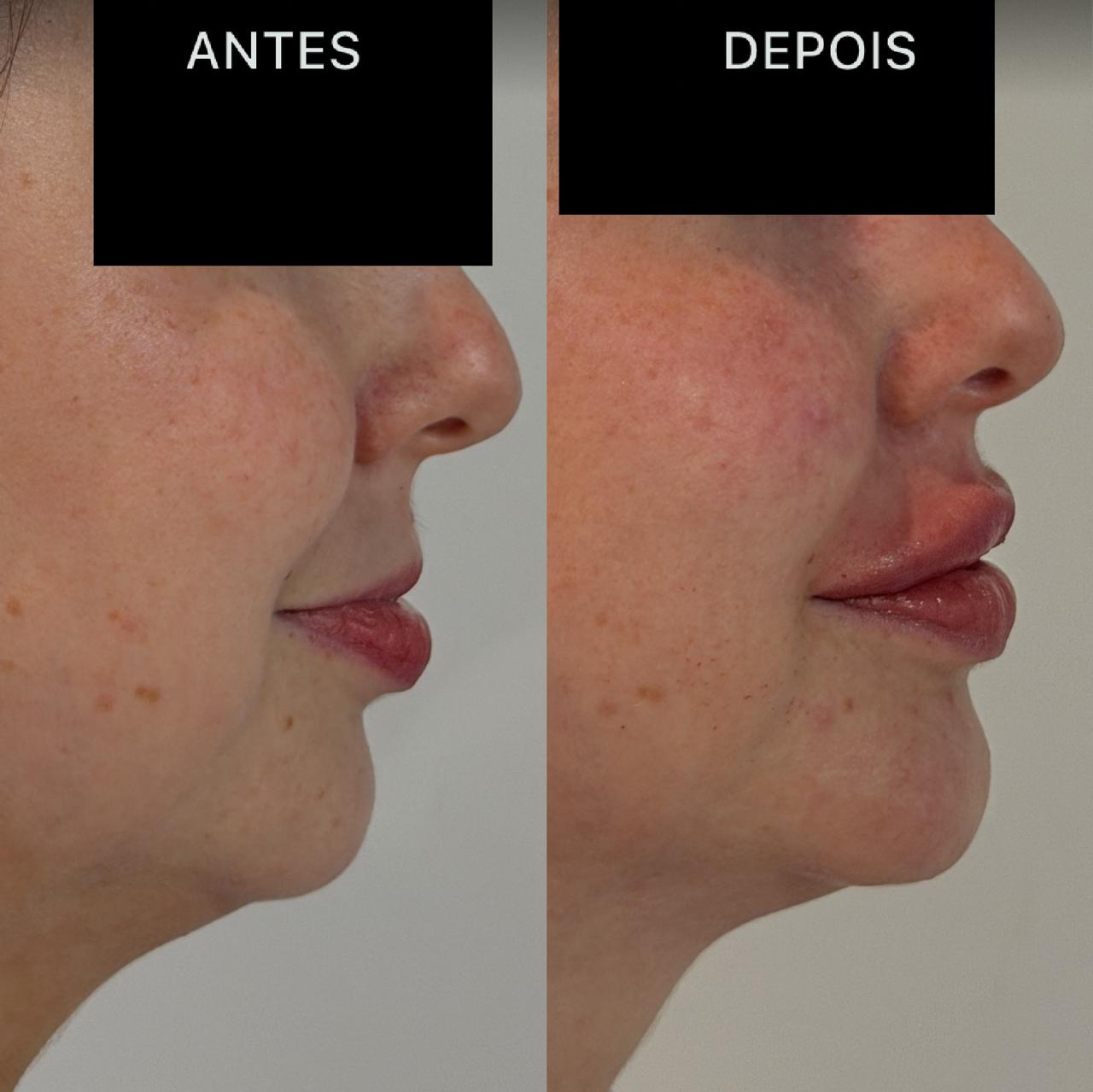 Antes e Depois Dra Lívia 31